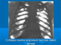 Туберкульома верхньої частки лівої легені