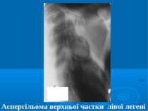 Аспергільома верхньої частки лівої легені