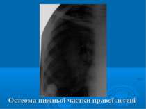 Остеома нижньої частки правої легені