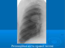 Ретенційна кіста правої легені