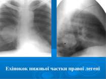 Ехінокок нижньої частки правої легені