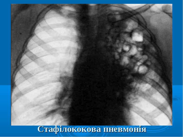 Стафілококова пневмонія