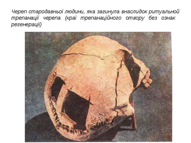 Череп стародавньої людини, яка загинула внаслидок ритуальной трепанації череп...