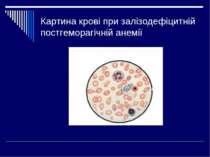 Картина крові при залізодефіцитній постгеморагічній анемії