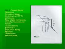 Мал. 6: Позиція дроту Кіршнера є, як показано вище. Це формує кут 30° до вісі...