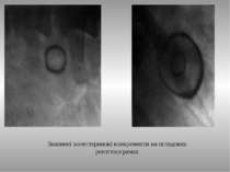 Звапнені холестеринові конкременти на оглядових рентгенограмах ТДМА