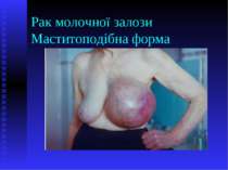 Рак молочної залози Маститоподібна форма