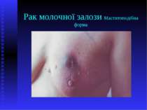 Рак молочної залози Маститоподібна форма