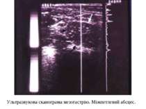Ультразвукова сканограма мезогастрію. Міжпетлевий абсцес.
