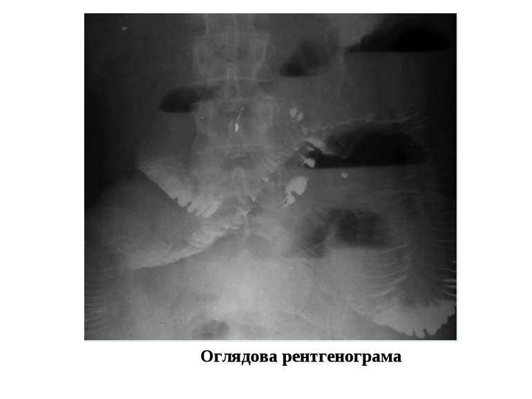 Оглядова рентгенограма брюшной полости. Пневматоз кишечника.