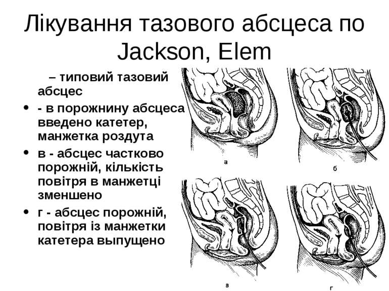 Лікування тазового абсцеса по Jackson, Elem а – типовий тазовий абсцес - в по...